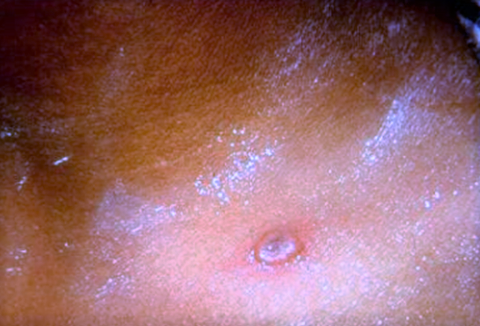 Chickenpox - Learn with OPEN